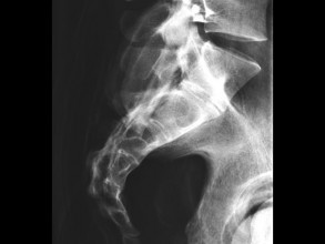 QUART X-Ray Spine Phantom 